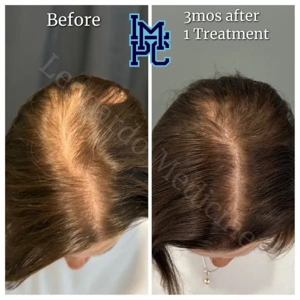 Needleless Hair treatment case 19