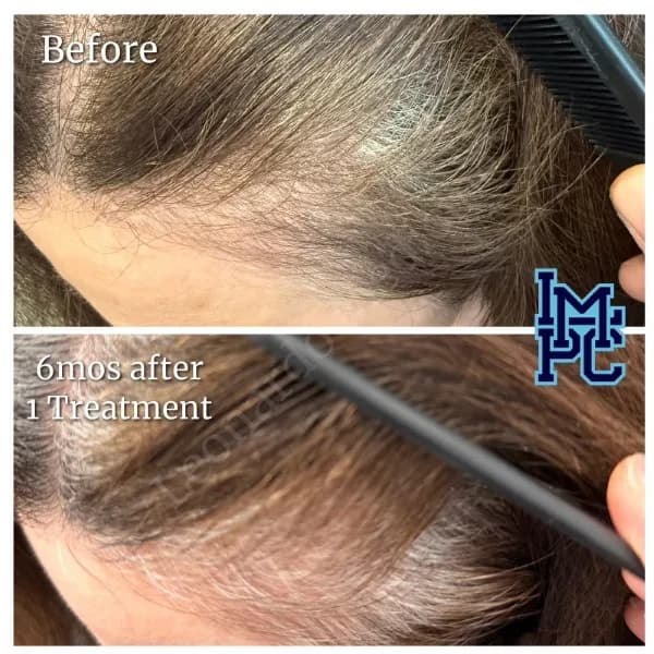 Needleless Hair treatment case 21