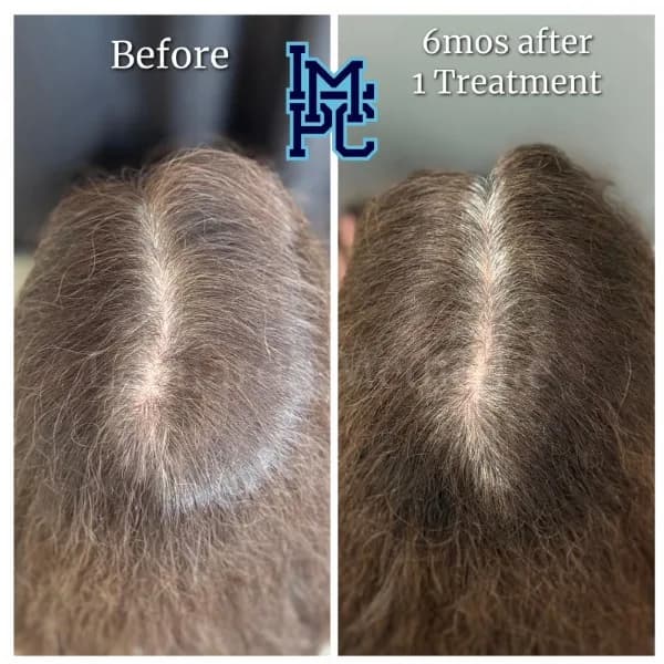 Needleless Hair treatment case 23