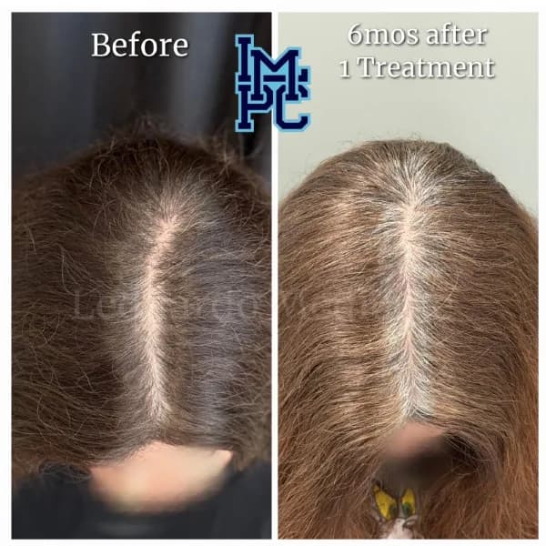 Needleless Hair treatment case 24