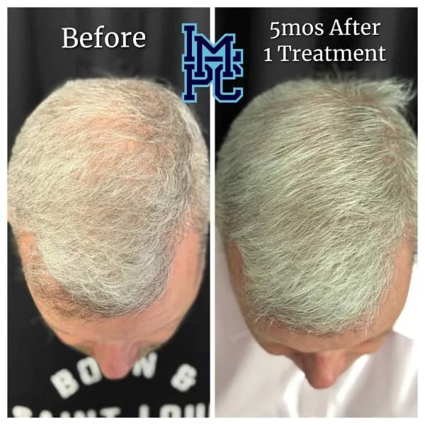 Needleless Hair treatment case 3