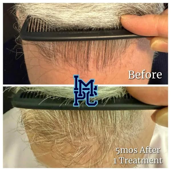 Needleless Hair treatment case 8
