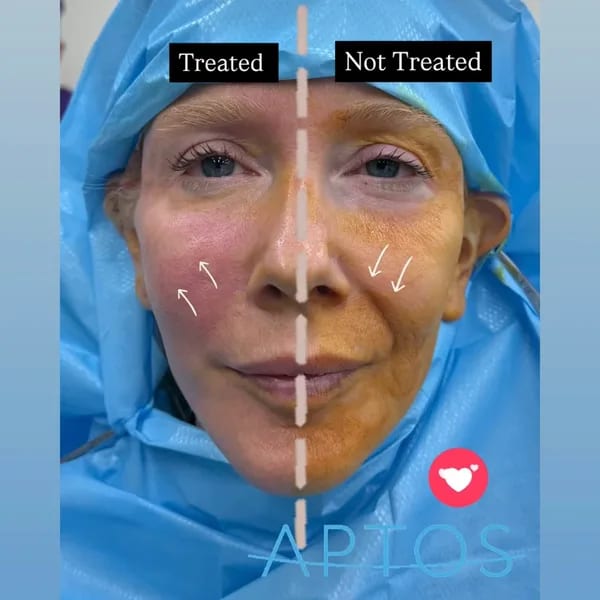 APTOS® Thread Lift case 19