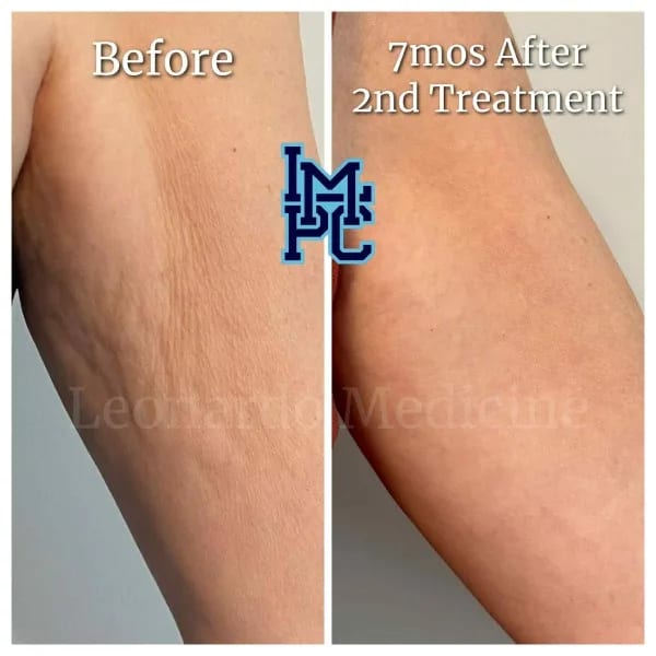 Dilute Radiesse case 1