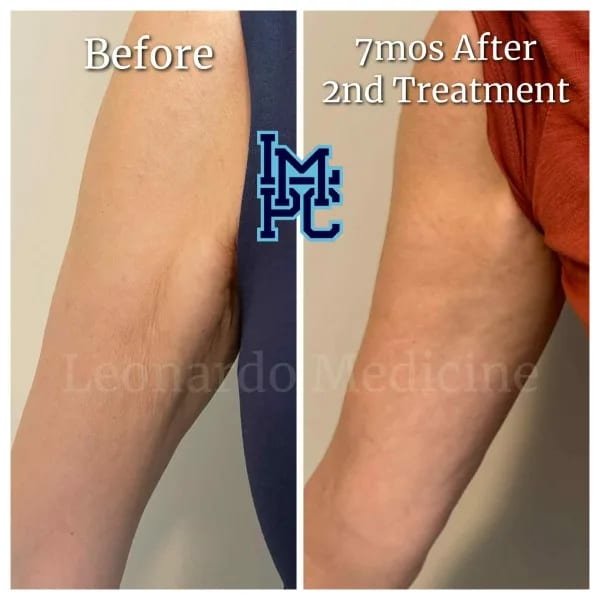 Dilute Radiesse case 10