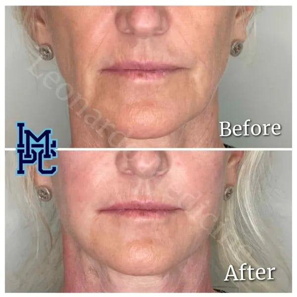 Dilute Radiesse case 12