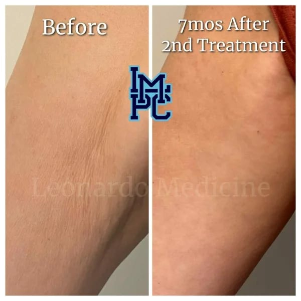 Dilute Radiesse case 13