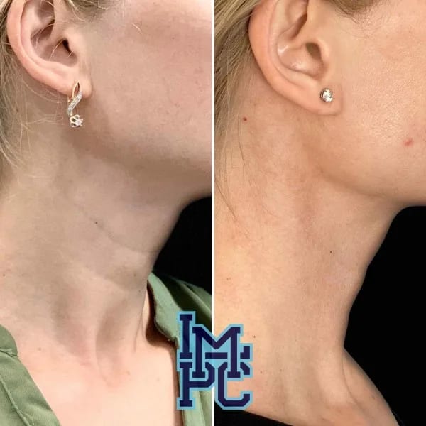 Dilute Radiesse case 16