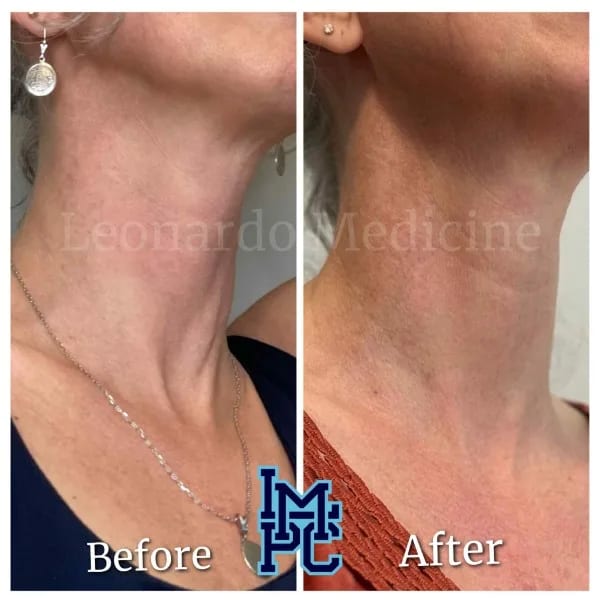 Dilute Radiesse case 18