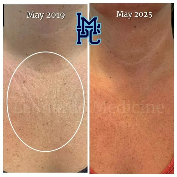 Dilute Radiesse case 19