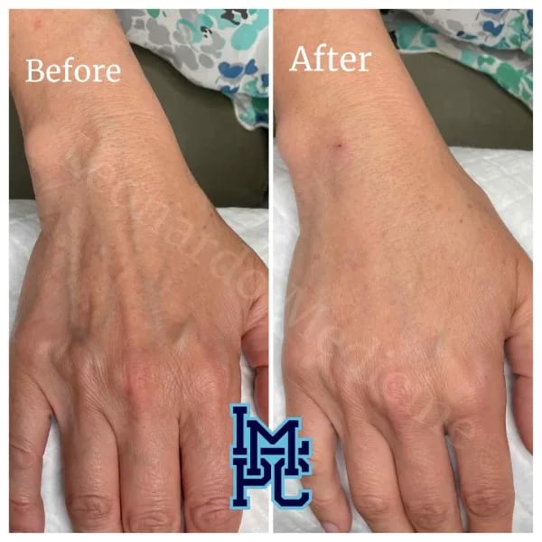 Dilute Radiesse case 2