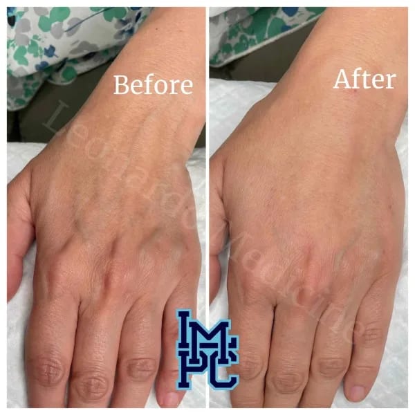 Dilute Radiesse case 22