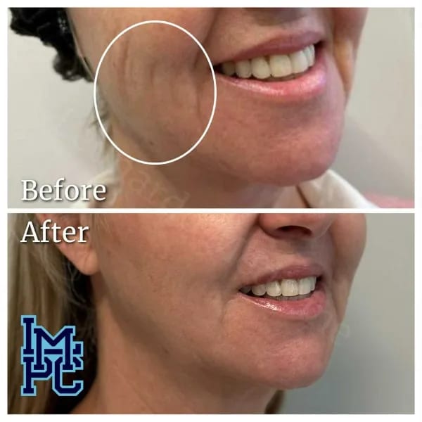 Dilute Radiesse case 23