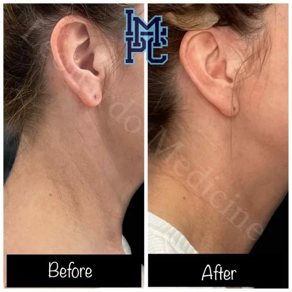 Dilute Radiesse case 24