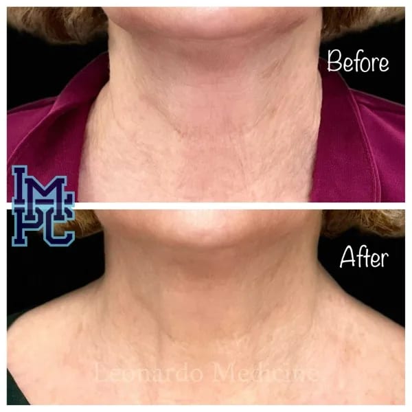 Dilute Radiesse case 25