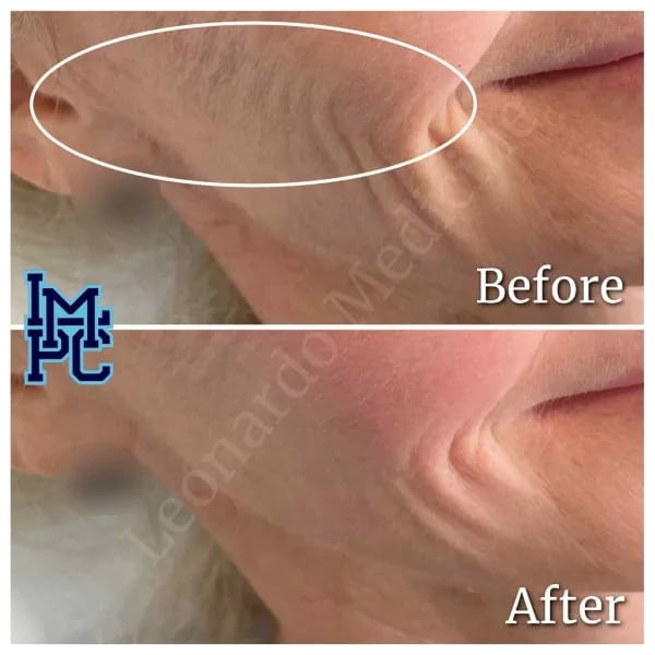 Dilute Radiesse case 27