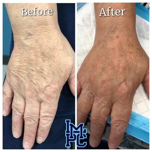 Dilute Radiesse case 28