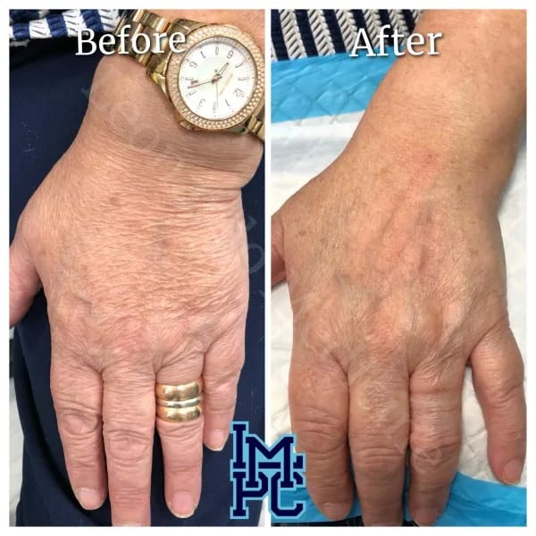 Dilute Radiesse case 29