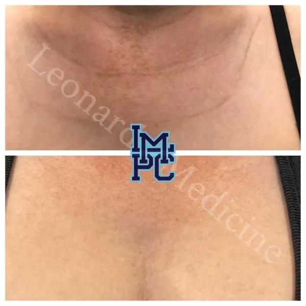 Dilute Radiesse case 3