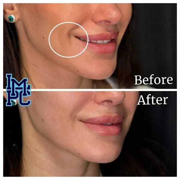 Dilute Radiesse case 30