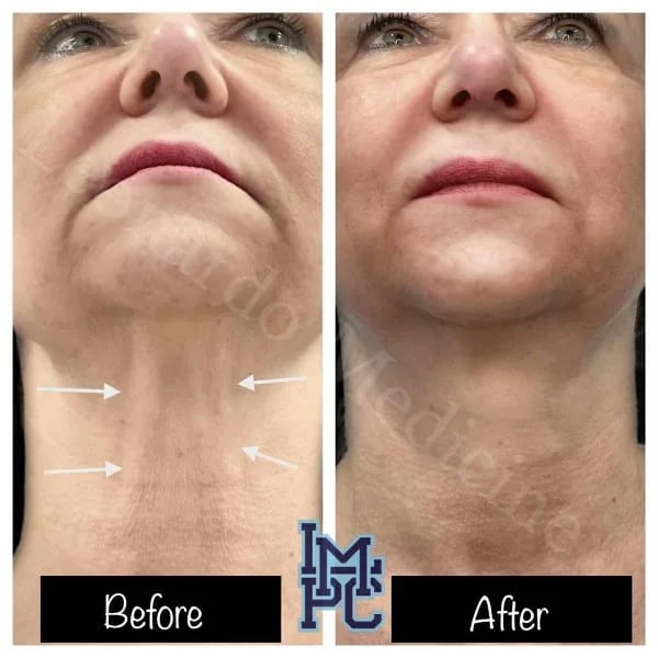 Dilute Radiesse case 5