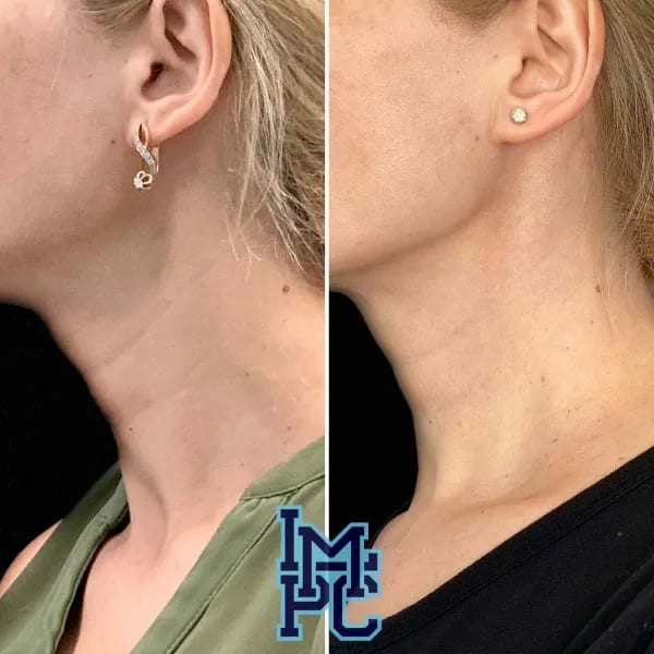 Dilute Radiesse case 6