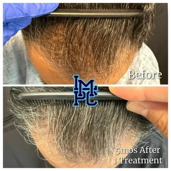 Needleless Hair case 1