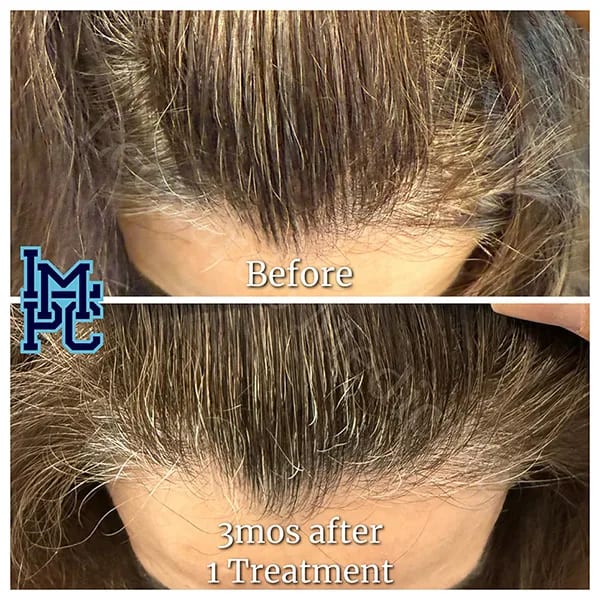 Needleless Hair case 10