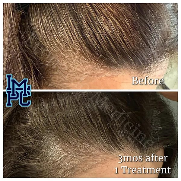 Needleless Hair case 12