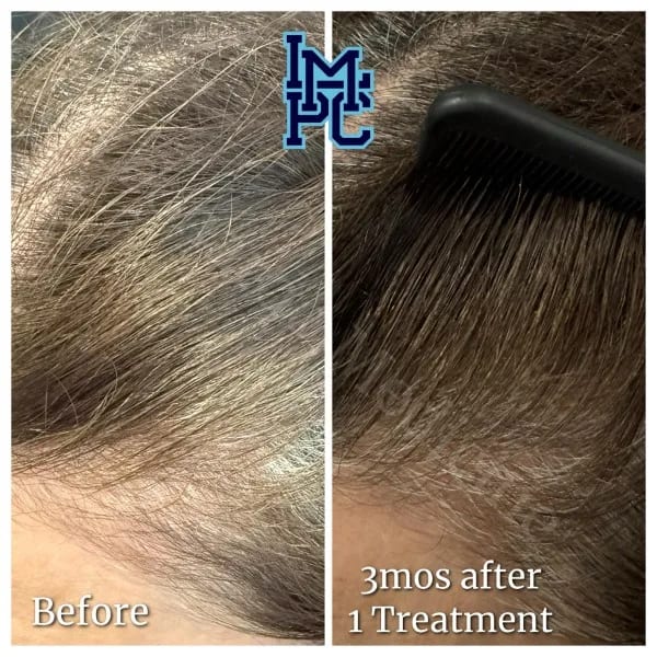 Needleless Hair case 13