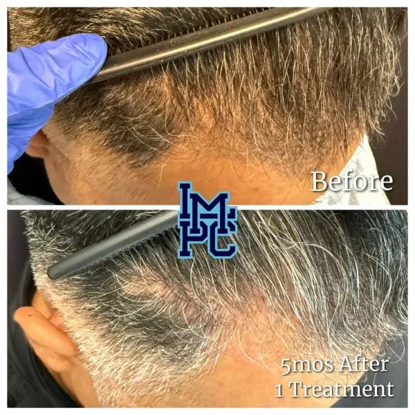 Needleless Hair case 6