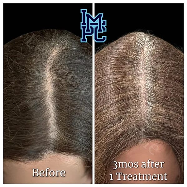 Needleless Hair case 9