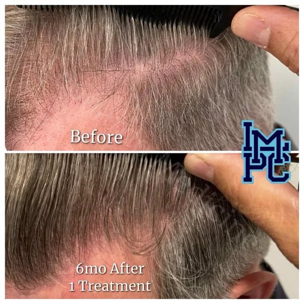 PRP Hair case 11