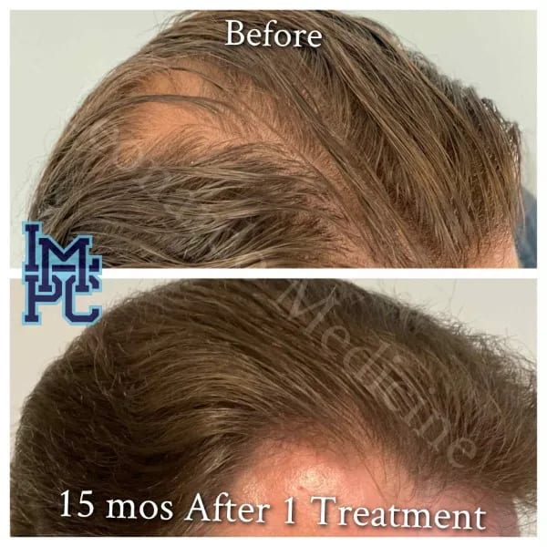 PRP Hair case 12