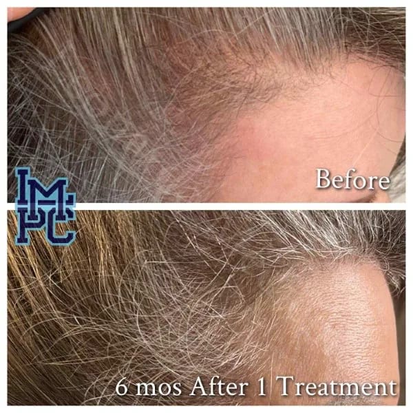 PRP Hair case 2