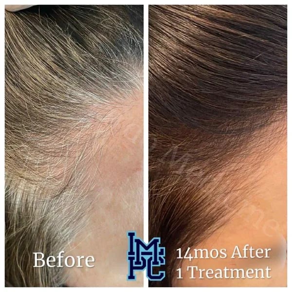 PRP Hair case 3