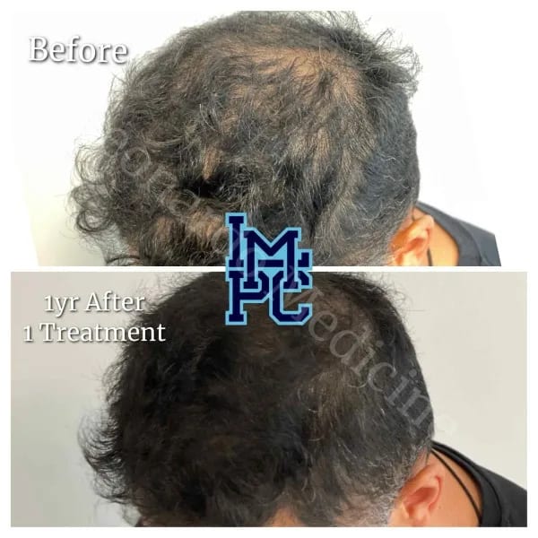 PRP Hair case 4