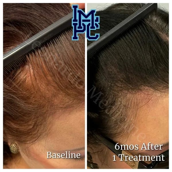 PRP Hair case 5