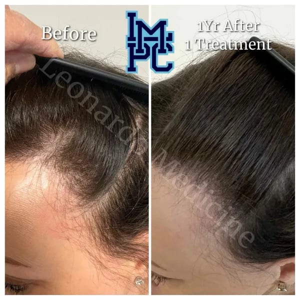 PRP Hair case 8