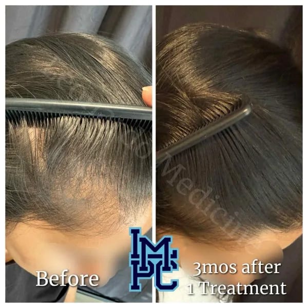 PRP Hair case 9