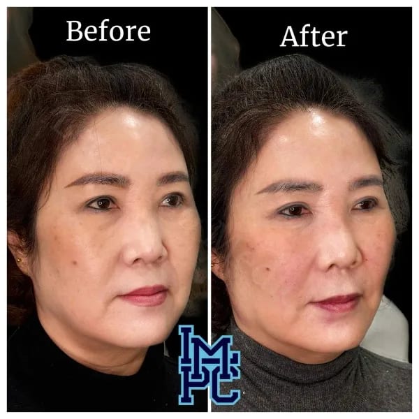 Sculptra case 1