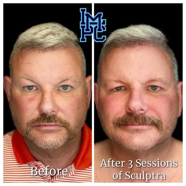 Sculptra case 10