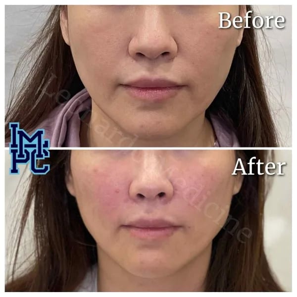 Sculptra case 2
