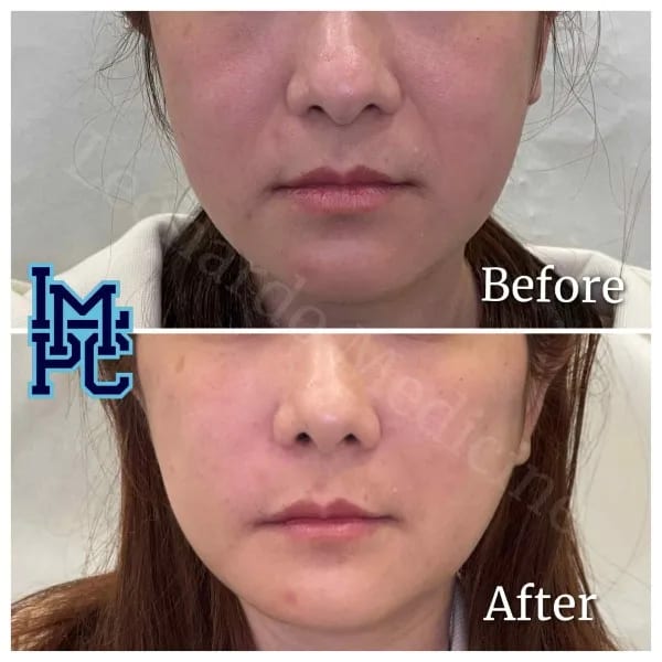Sculptra case 3