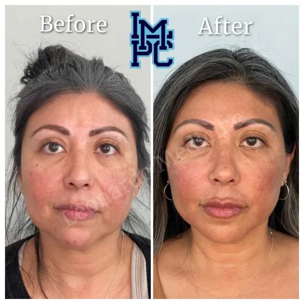 Sculptra case 4