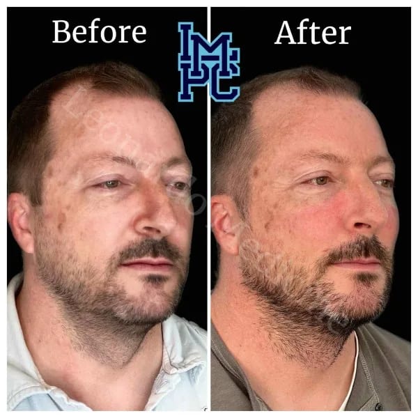 Sculptra case 5