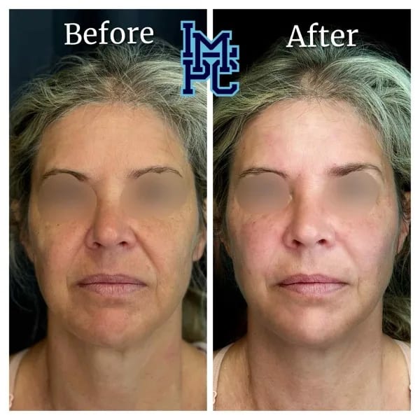 Sculptra case 6