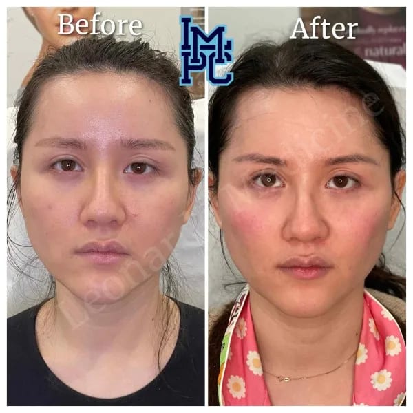 Sculptra case 7