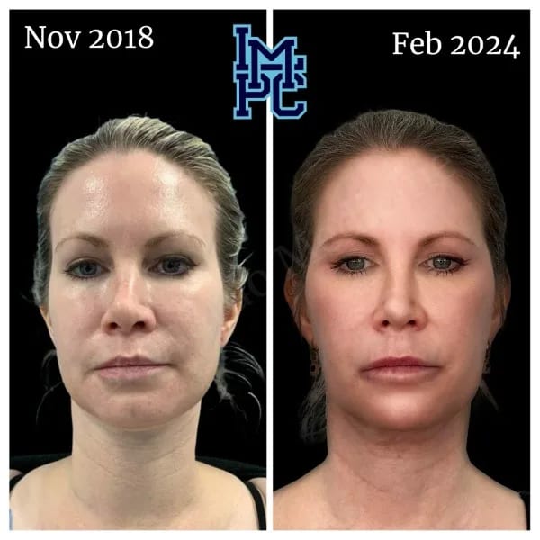 Sculptra case 9