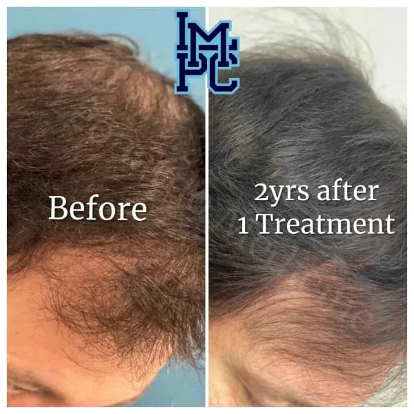 PRP Hair Treatment case 1